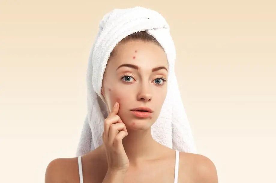 Top 3 Ways How CBD Hemp Oil Helps In Acne Reduction Due To Hormones.
