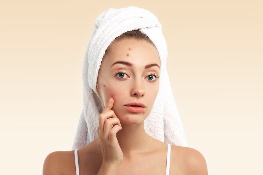 Top 3 Ways How CBD Hemp Oil Helps In Acne Reduction Due To Hormones - CBD Store India