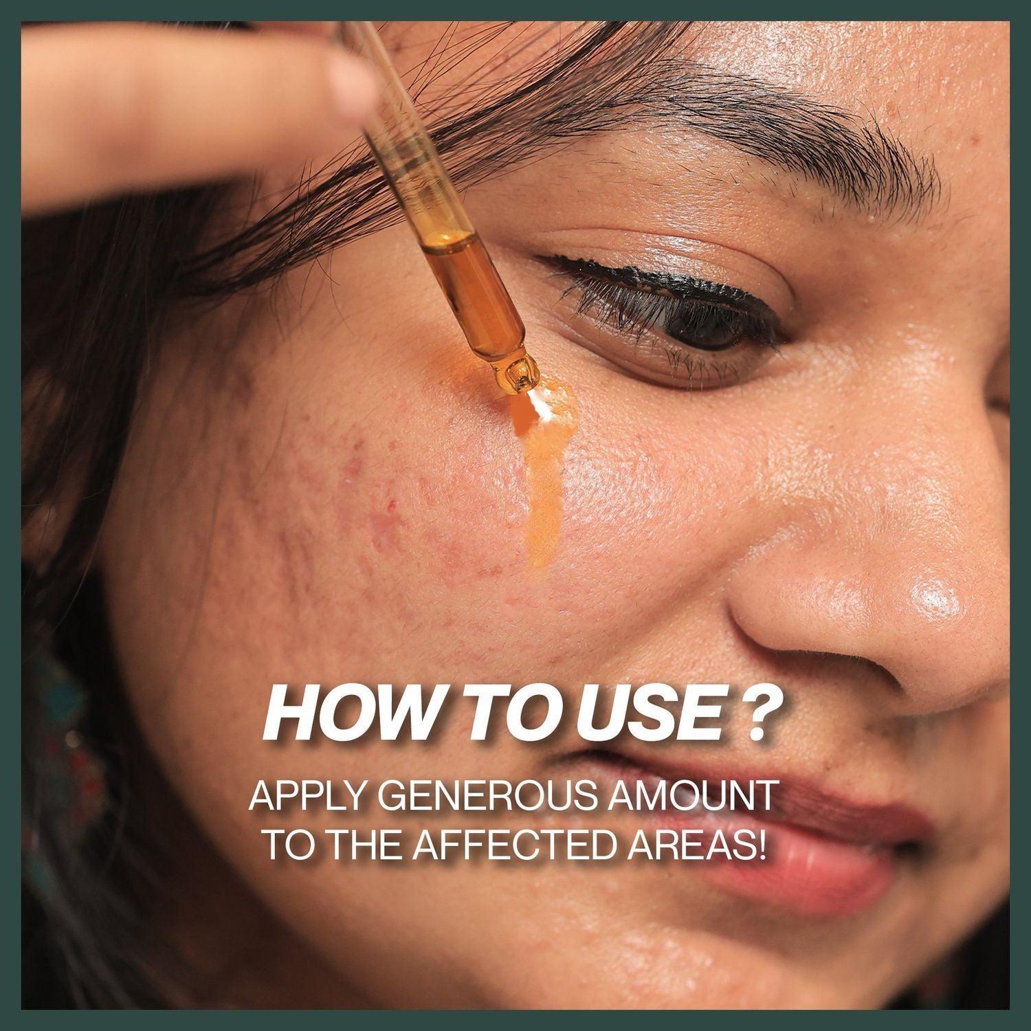 Hempbuti- Acne Oil 50 Ml.