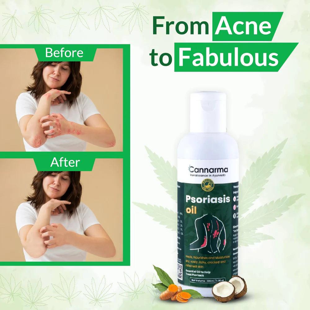 Cannarma- Psoriasis Oilskin care oilCannarma Psoriasis Oil - Psoriasis Ayurvedic Oil | Natural Relief
